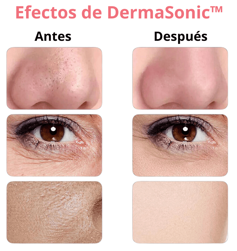 DermaSonic™ - Peeling Ultrasónico Profesional